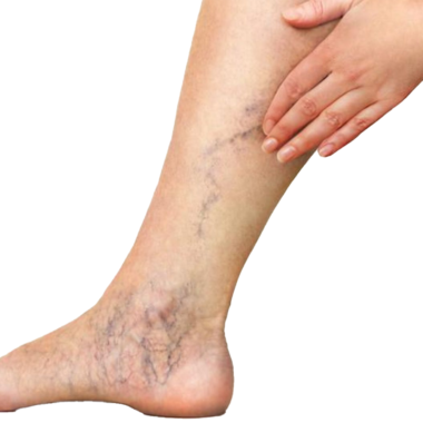 Varicose Veins